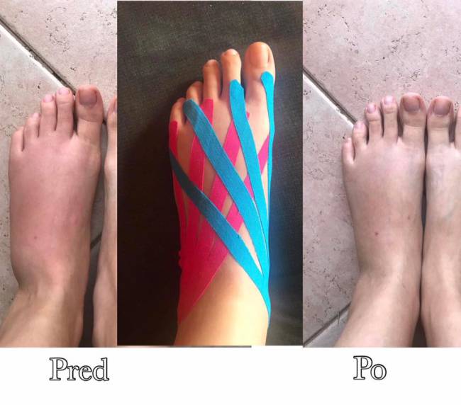 kinesiotaping